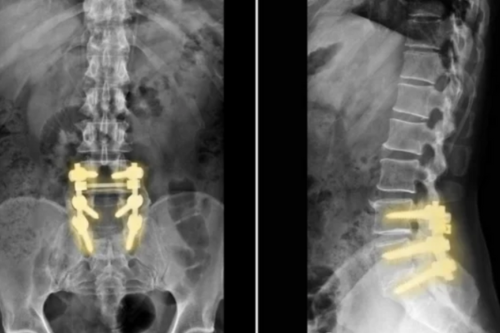 Lumbar Spinal Fusion